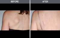 Lipoma Removal Gallery Before & After Gallery - Patient 4448359 - Image 1