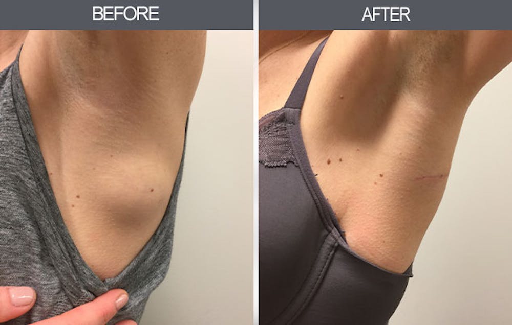 Lipoma Removal Gallery Before & After Gallery - Patient 4448360 - Image 2