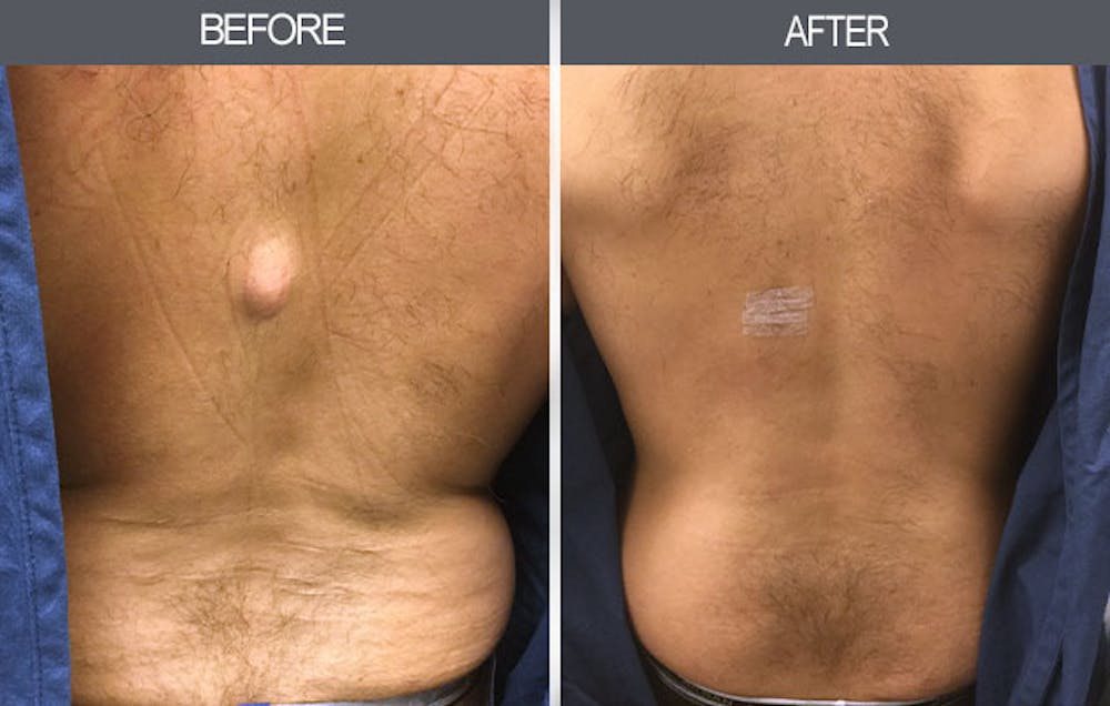 Lipoma Removal Gallery Before & After Gallery - Patient 4448465 - Image 1