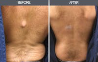 Lipoma Removal Before & After Gallery - Patient 4448465 - Image 1