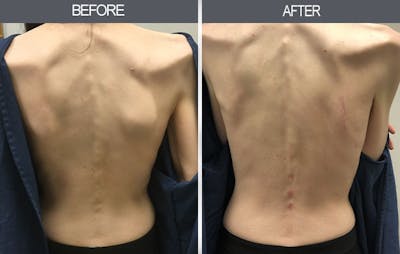 Lipoma Removal Gallery Before & After Gallery - Patient 4448466 - Image 1