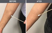 Lipoma Removal Before & After Gallery - Patient 4448467 - Image 1