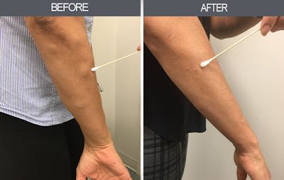 Lipoma Removal Gallery Before & After Gallery - Patient 4448467 - Image 2