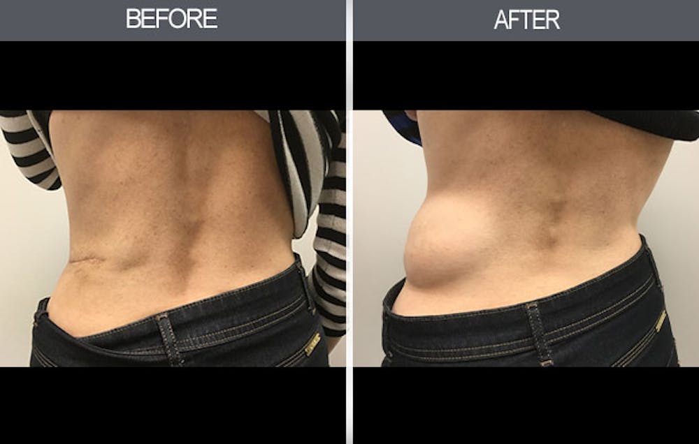 Lipoma Removal Before & After Gallery - Patient 4448468 - Image 1
