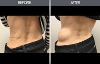 Lipoma Removal Before & After Gallery - Patient 4448468 - Image 1