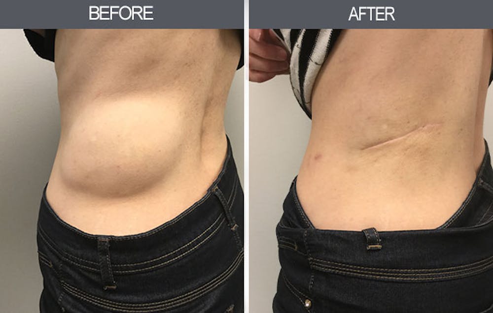 Lipoma Removal Gallery Before & After Gallery - Patient 4448468 - Image 1