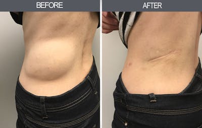 Lipoma Removal Before & After Gallery - Patient 4448468 - Image 2