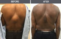 Lipoma Removal Before & After Gallery - Patient 4448469 - Image 1