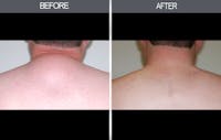 Lipoma Removal Before & After Gallery - Patient 4448470 - Image 1