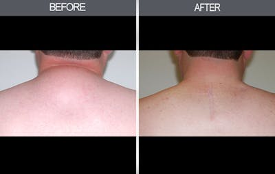 Lipoma Removal Gallery Before & After Gallery - Patient 4448470 - Image 1