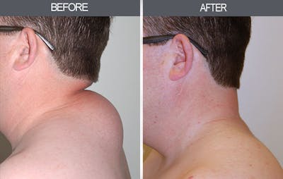 Lipoma Removal Before & After Gallery - Patient 4448470 - Image 2
