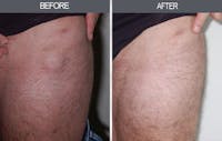 Lipoma Removal Before & After Gallery - Patient 4448471 - Image 1