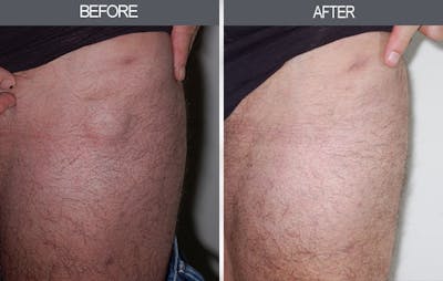 Lipoma Removal Gallery Before & After Gallery - Patient 4448471 - Image 1