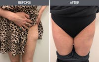 Lipoma Removal Gallery Before & After Gallery - Patient 4448473 - Image 1