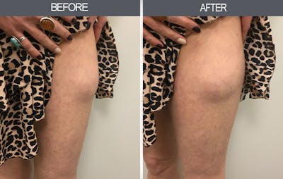 Lipoma Removal Gallery Before & After Gallery - Patient 4448473 - Image 2