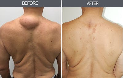 Lipoma Removal Gallery Before & After Gallery - Patient 4448474 - Image 1