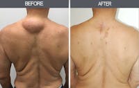 Lipoma Removal Before & After Gallery - Patient 4448474 - Image 1