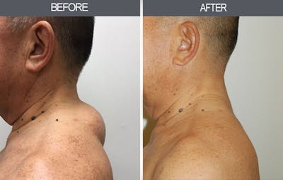 Lipoma Removal Gallery Before & After Gallery - Patient 4448474 - Image 2