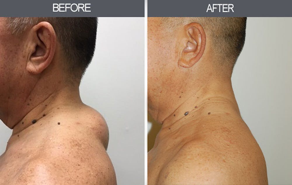 Lipoma Removal Before & After Gallery - Patient 4448474 - Image 2