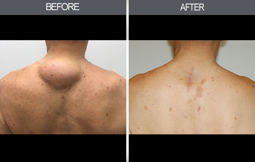Lipoma Removal Gallery Before & After Gallery - Patient 4448474 - Image 3