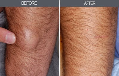 Lipoma Removal Gallery Before & After Gallery - Patient 4448544 - Image 1
