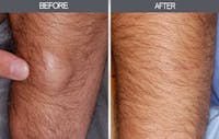 Lipoma Removal Before & After Gallery - Patient 4448544 - Image 1