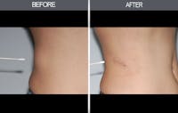 Lipoma Removal Gallery Before & After Gallery - Patient 4448545 - Image 1