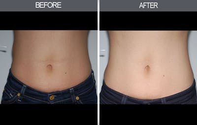 Lipoma Removal Gallery Before & After Gallery - Patient 4448545 - Image 2