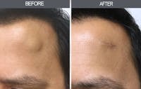 Lipoma Removal Before & After Gallery - Patient 4448546 - Image 1