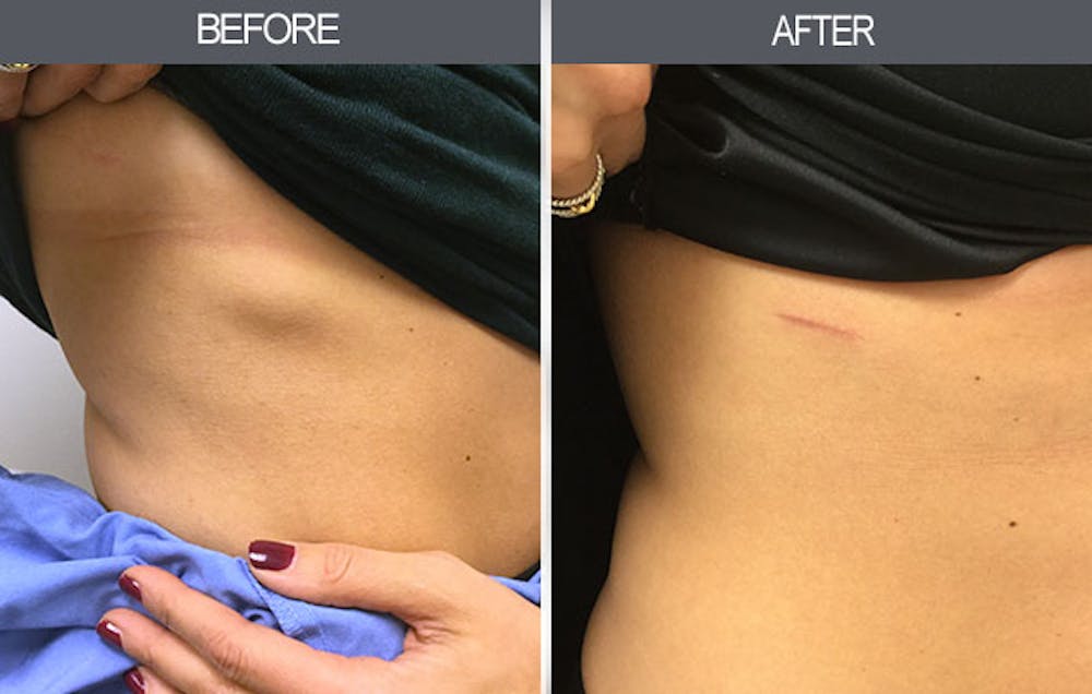 Lipoma Removal Before & After Gallery - Patient 4448547 - Image 1