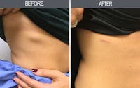 Lipoma Removal Before & After Gallery - Patient 4448547 - Image 1