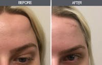 Lipoma Removal Gallery Before & After Gallery - Patient 4448548 - Image 1