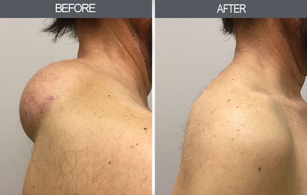 Lipoma Removal Gallery Before & After Gallery - Patient 4448579 - Image 1