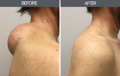 Lipoma Removal Gallery Before & After Gallery - Patient 4448579 - Image 1