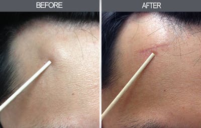 Lipoma Removal Gallery Before & After Gallery - Patient 4448580 - Image 1