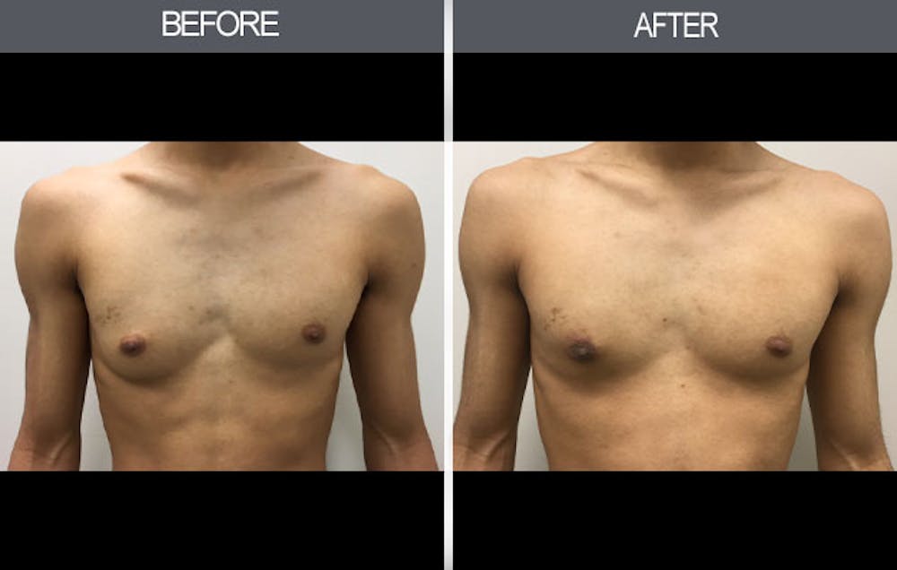 Male Breast Reduction (Gynecomastia) Gallery Before & After Gallery - Patient 4448716 - Image 1
