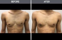 Male Breast Reduction (Gynecomastia) Gallery Before & After Gallery - Patient 4448716 - Image 1