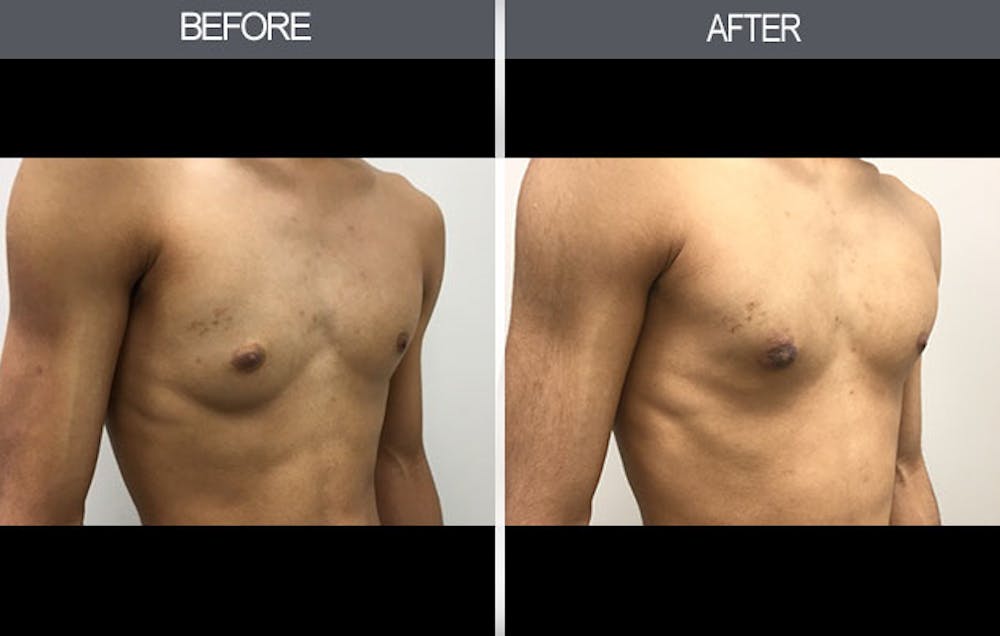 Male Breast Reduction (Gynecomastia) Gallery Before & After Gallery - Patient 4448716 - Image 2