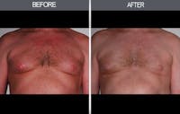 Male Breast Reduction (Gynecomastia) Gallery Before & After Gallery - Patient 4448717 - Image 1