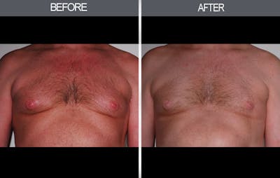 Male Breast Reduction (Gynecomastia) Gallery Before & After Gallery - Patient 4448717 - Image 1