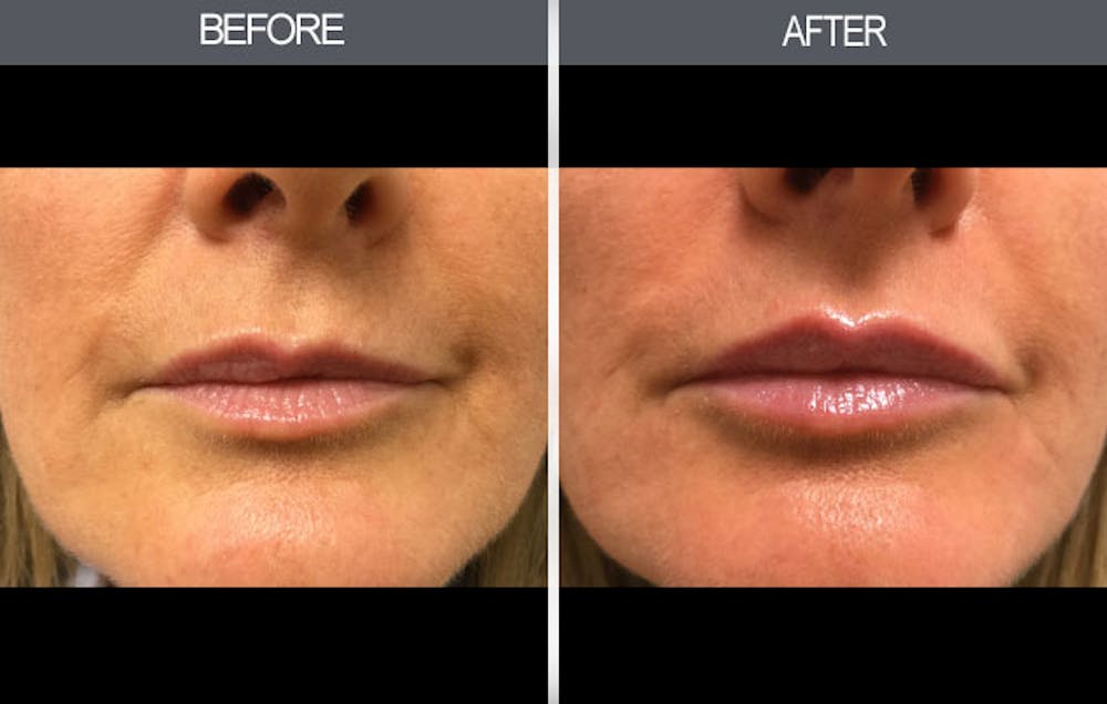 Lip Fillers Gallery Before & After Gallery - Patient 149147497 - Image 1