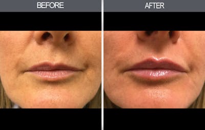 Lip Fillers Gallery Before & After Gallery - Patient 149147497 - Image 1