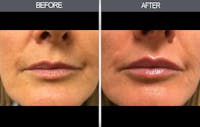 Lip Fillers Before & After Gallery - Patient 149147497 - Image 1