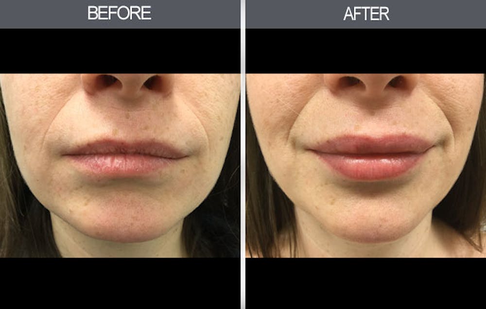 Lip Fillers Gallery Before & After Gallery - Patient 149147496 - Image 1