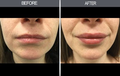 Lip Fillers Gallery Before & After Gallery - Patient 149147496 - Image 1