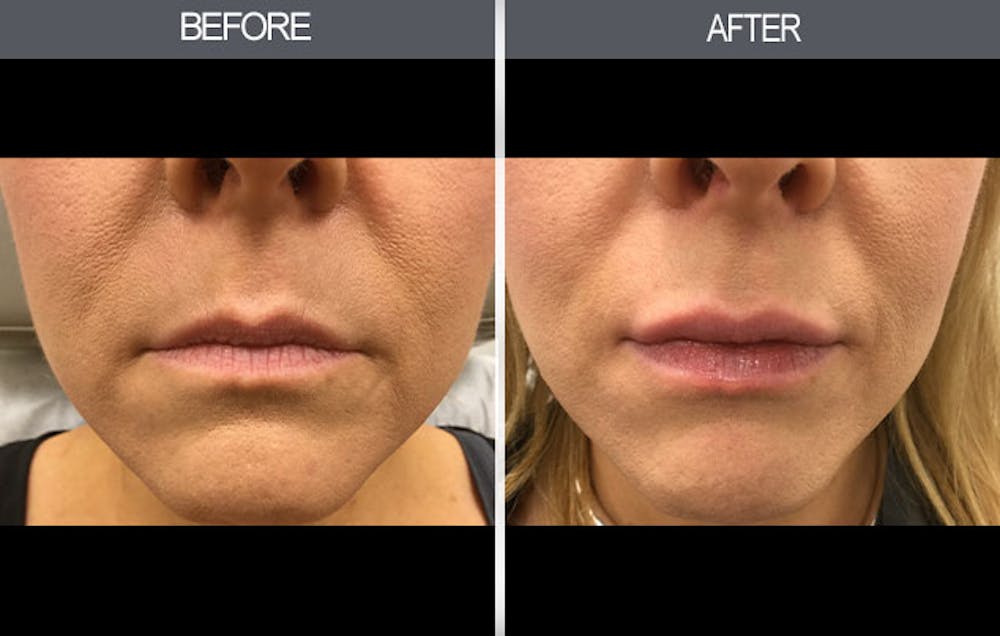 Lip Fillers Gallery Before & After Gallery - Patient 149147495 - Image 1