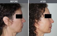 Facelift and Mini Facelift Gallery Before & After Gallery - Patient 4449145 - Image 1