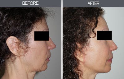 Facelift and Mini Facelift Gallery Before & After Gallery - Patient 4449145 - Image 1
