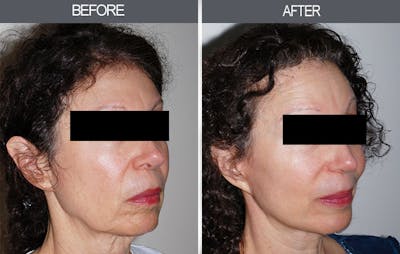Facelift and Mini Facelift Gallery Before & After Gallery - Patient 4449145 - Image 2