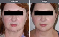 Facelift and Mini Facelift Gallery Before & After Gallery - Patient 4449146 - Image 1